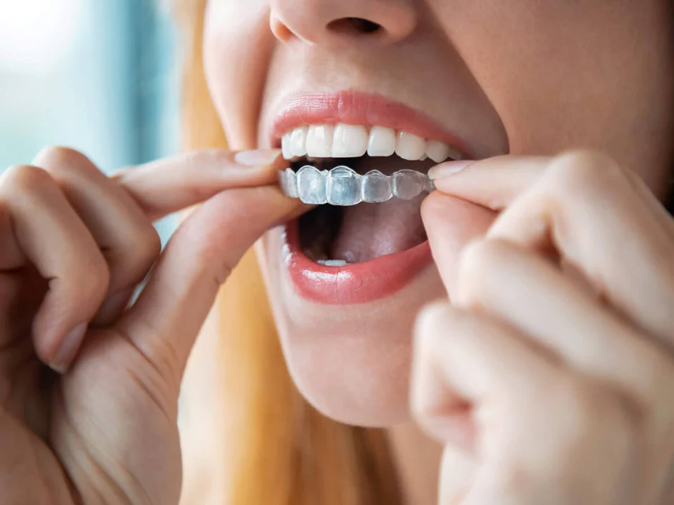 Invisalign<sup>®</sup>